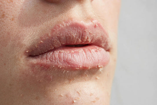 Close-up of dry, chapped lips with mild redness and irritation